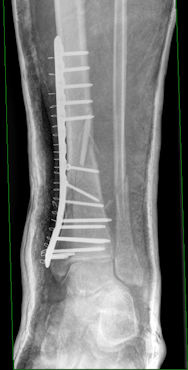Reichlich Metall im Bein.